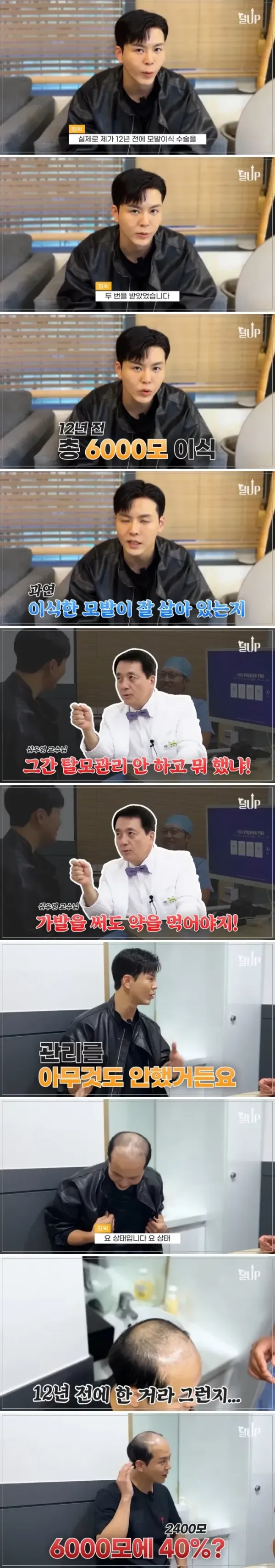 18 모발이식 12년 후 근황.webp